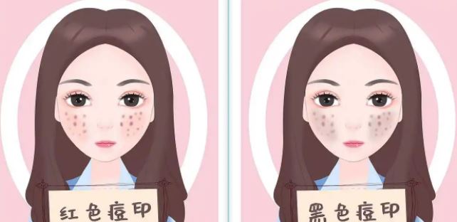 臉上紅色痘印幾個(gè)月都不消怎么辦？紅色痘印應(yīng)該怎么消除？