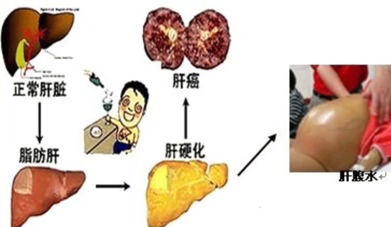 查出肝硬化還有救嗎？