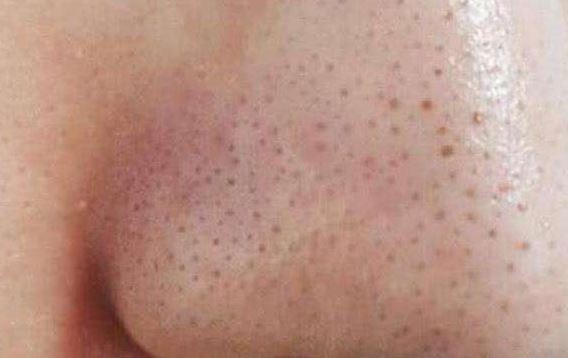 清潔面膜哪個牌子可以快速祛黑頭？趙薇、薇婭 推薦的紐西之謎泥膜真的好用嗎？